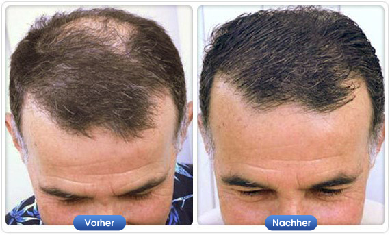 DermMatch Vorher-Nachher-Ergebnis mit DermMatch Schwarz bei lichtem Haar