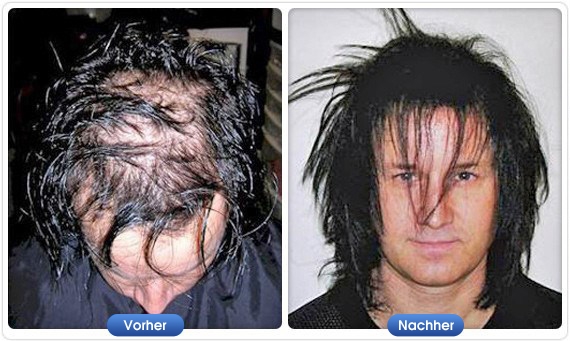 DermMatch Vorher-Nachher-Ergebnis mit DermMatch Schwarz bei fortgeschrittenem Haarverlust