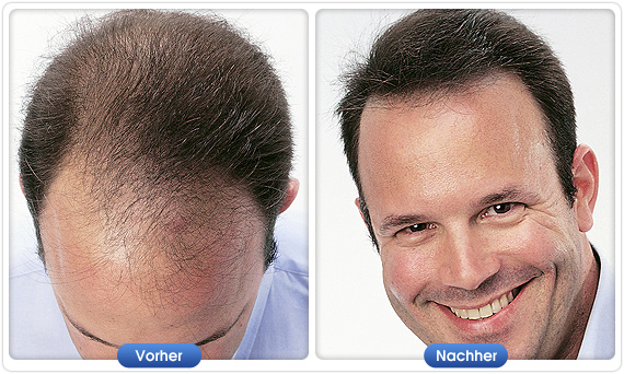 Vorher-Nachher-Ergebnis mit DermMatch bei lichtem Haar und sichtbarer Kopfhaut