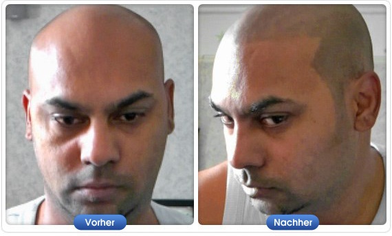 DermMatch Vorher-Nachher-Ergebnis bei sehr kurzem Haar und sichtbarer Kopfhaut